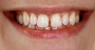Niềng răng thưa có đau không?